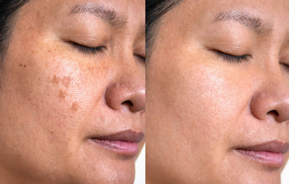 age-spot-treatment-before-after-milledgeville-ga.jpg 1757703700 b73032a1628144b09decb5c022ab2656 1
