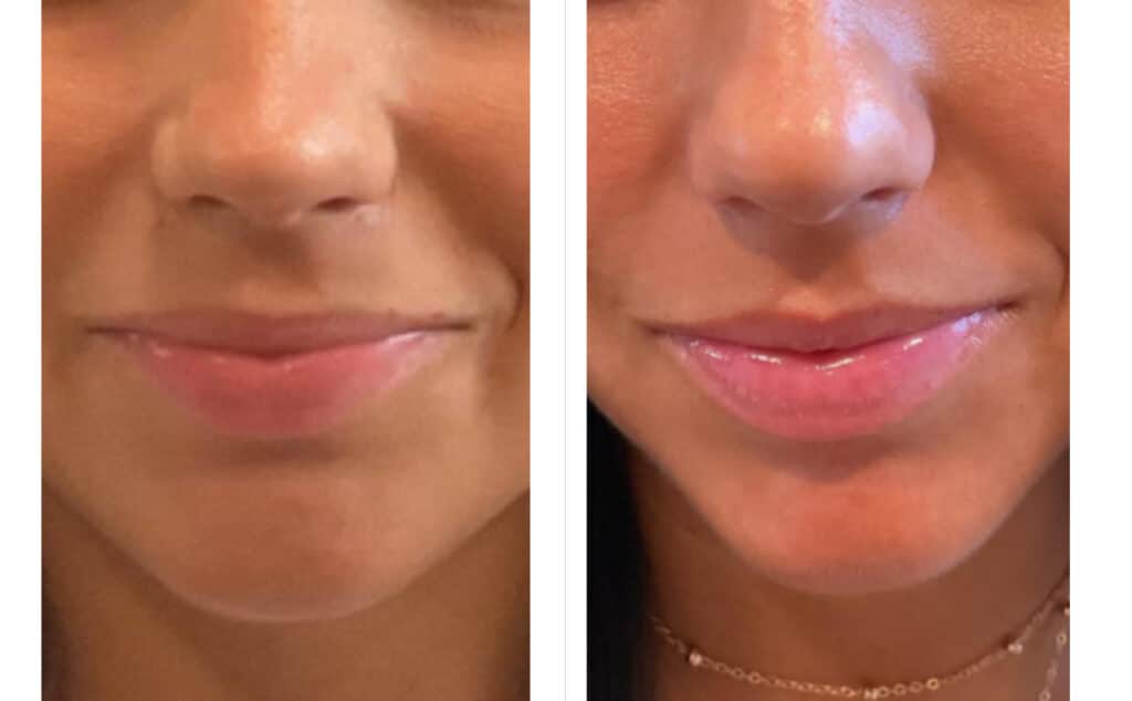 Before and After Image: Botox Flip - front