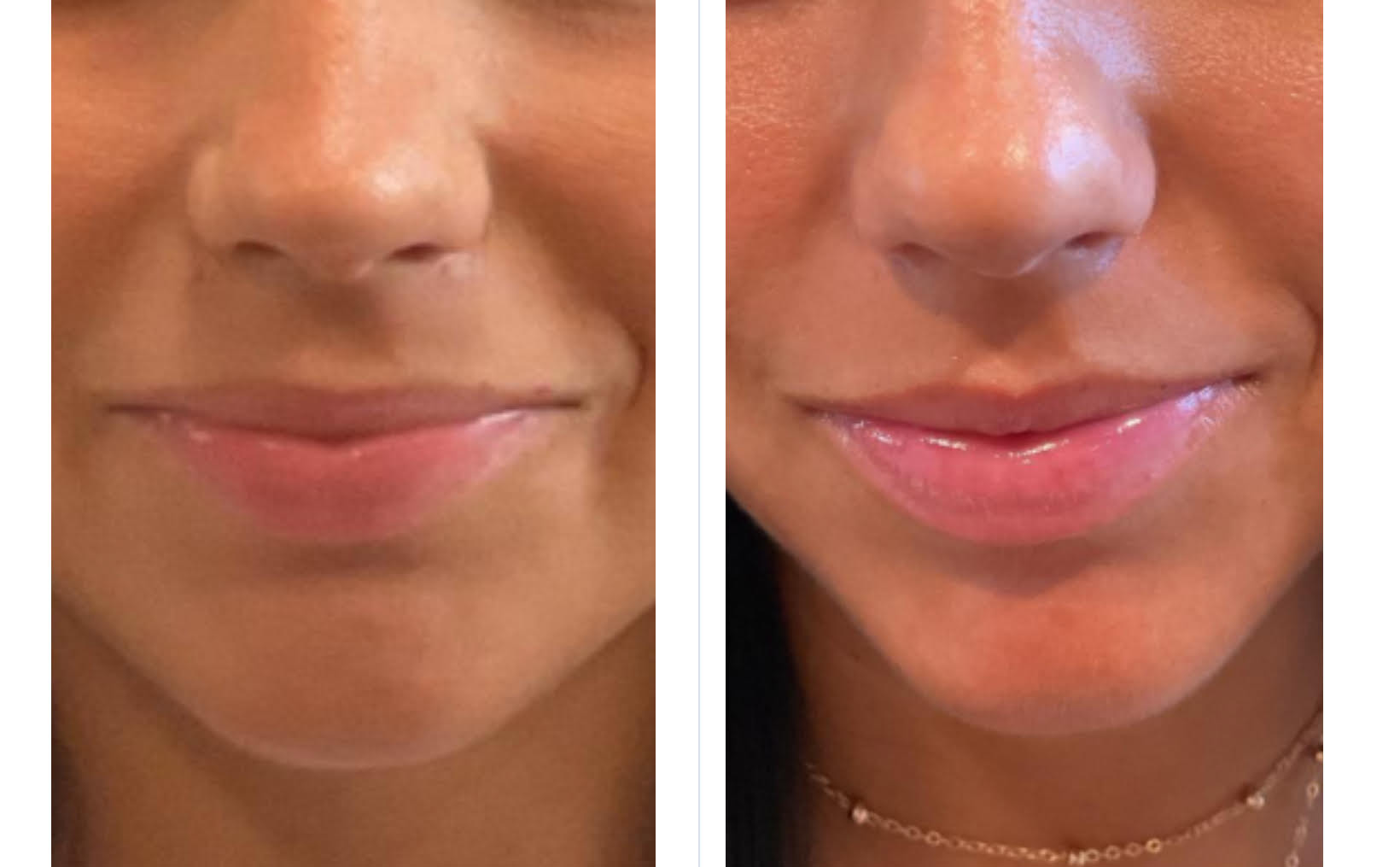 Before and After Image: Botox Flip - front