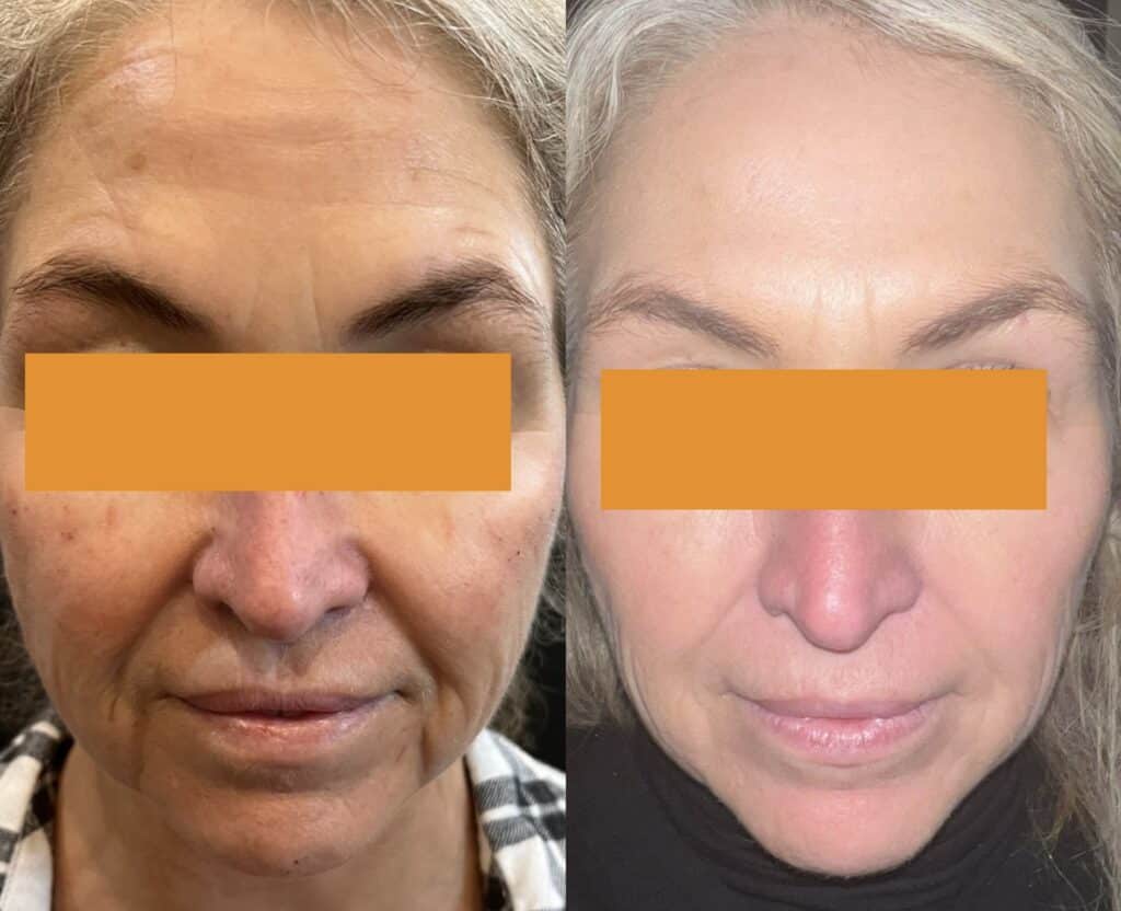 Before and After Image: Full face balancing Botox, PDO Threads, Juvederm Filler, HydraFacial - front