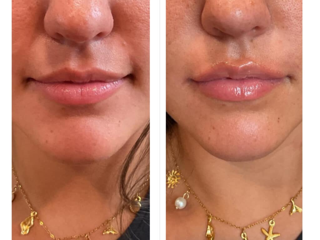 Before and After Image: Restylane Volbella Lip Filler - front