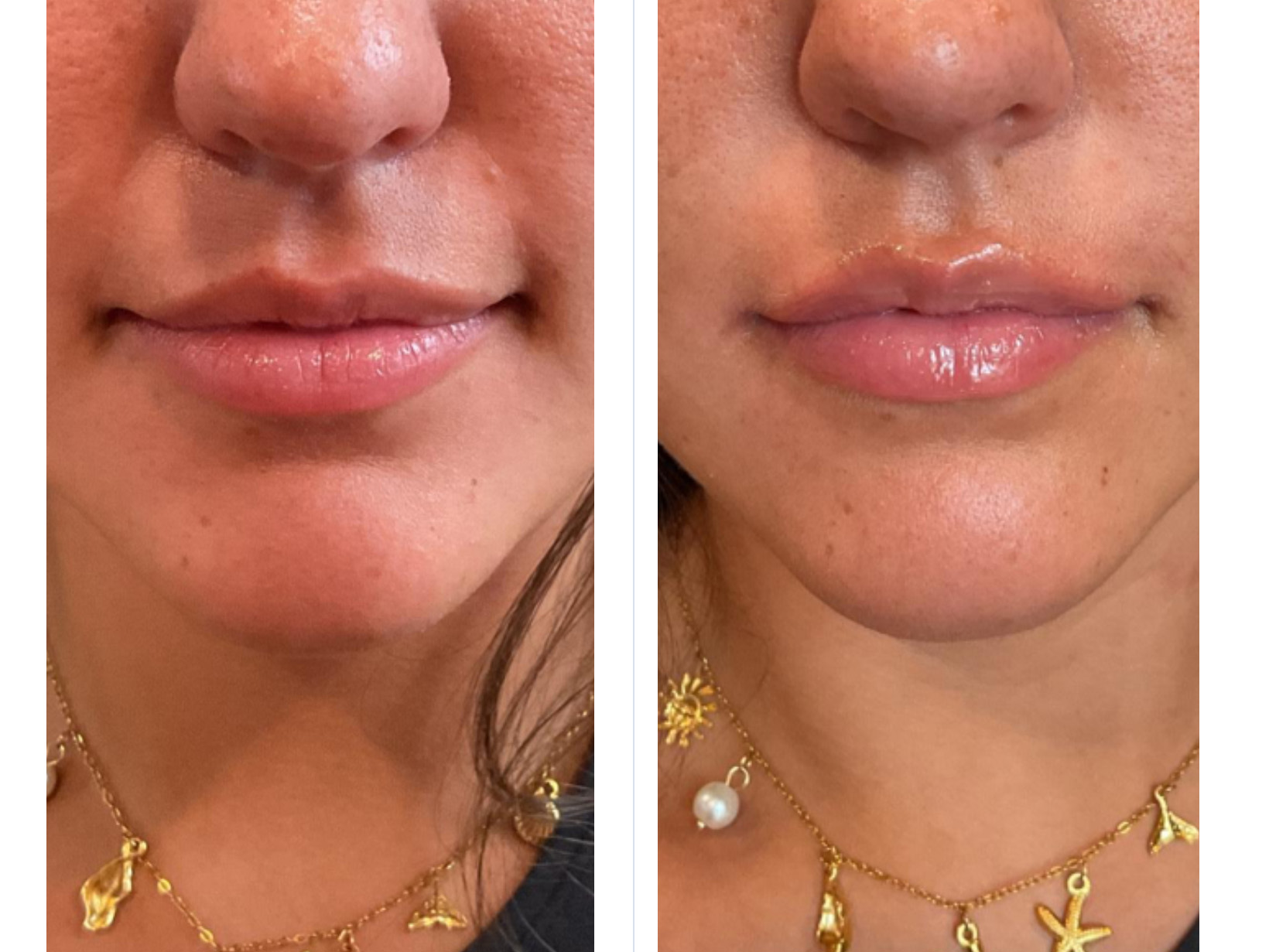 Before and After Image: Restylane Volbella Lip Filler - front