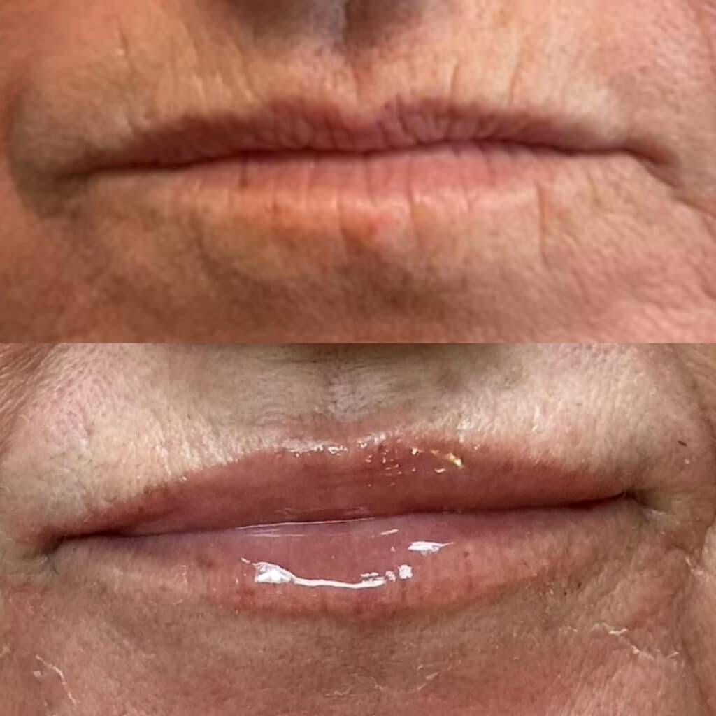 Before and After Image: Ultra XC Lip Filler - front