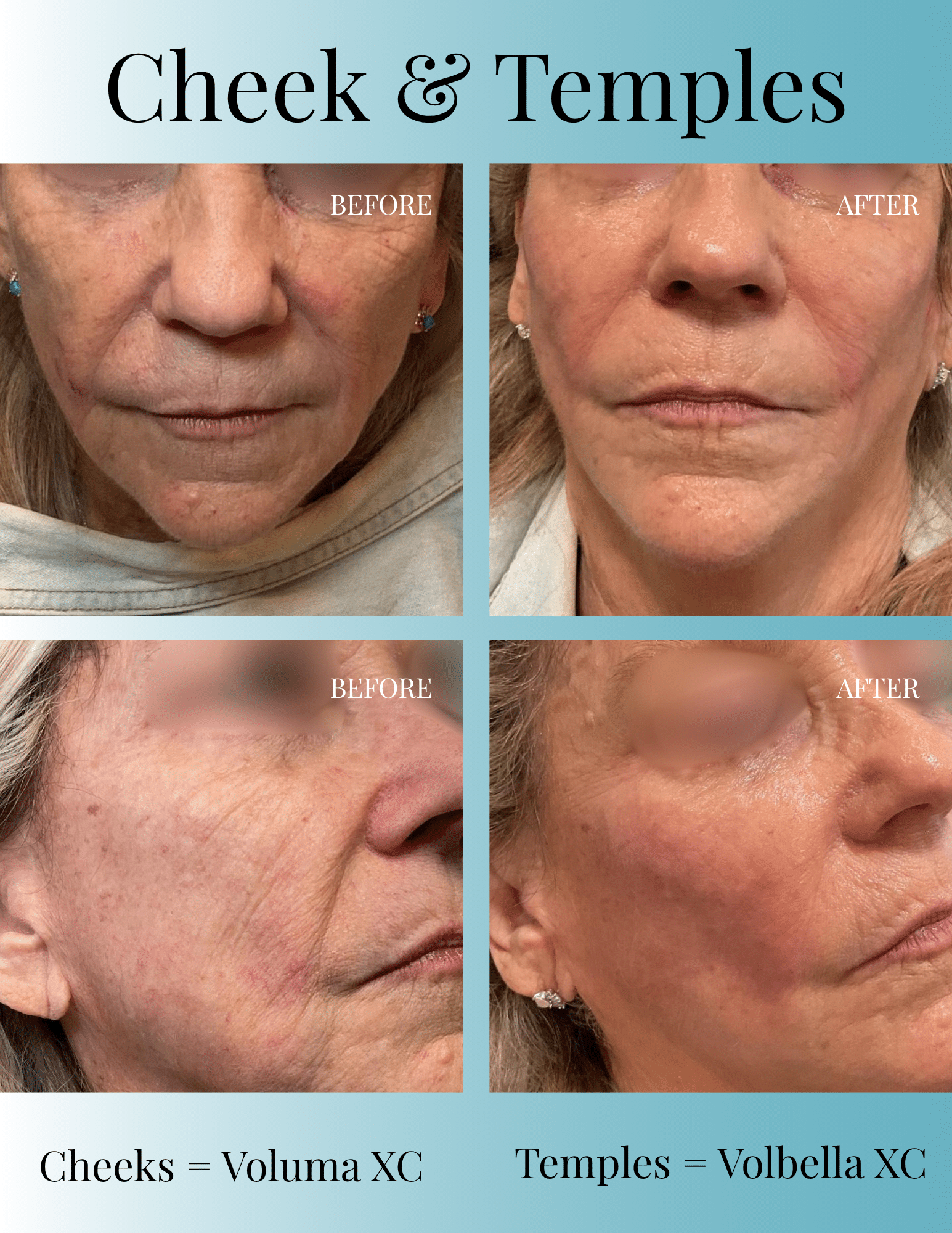 Before and After Image: Cheek and Temple Filler Before and After - front