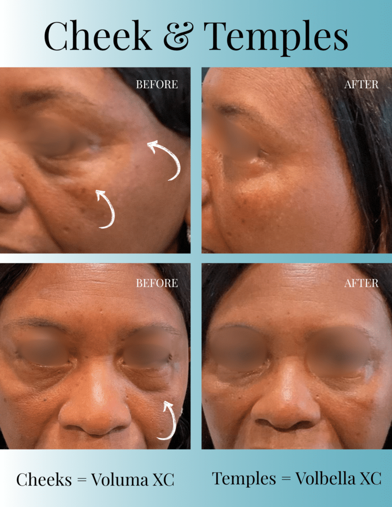 Before and After Image: Cheek & Temple Filler Before & After | Milledgeville, GA - front