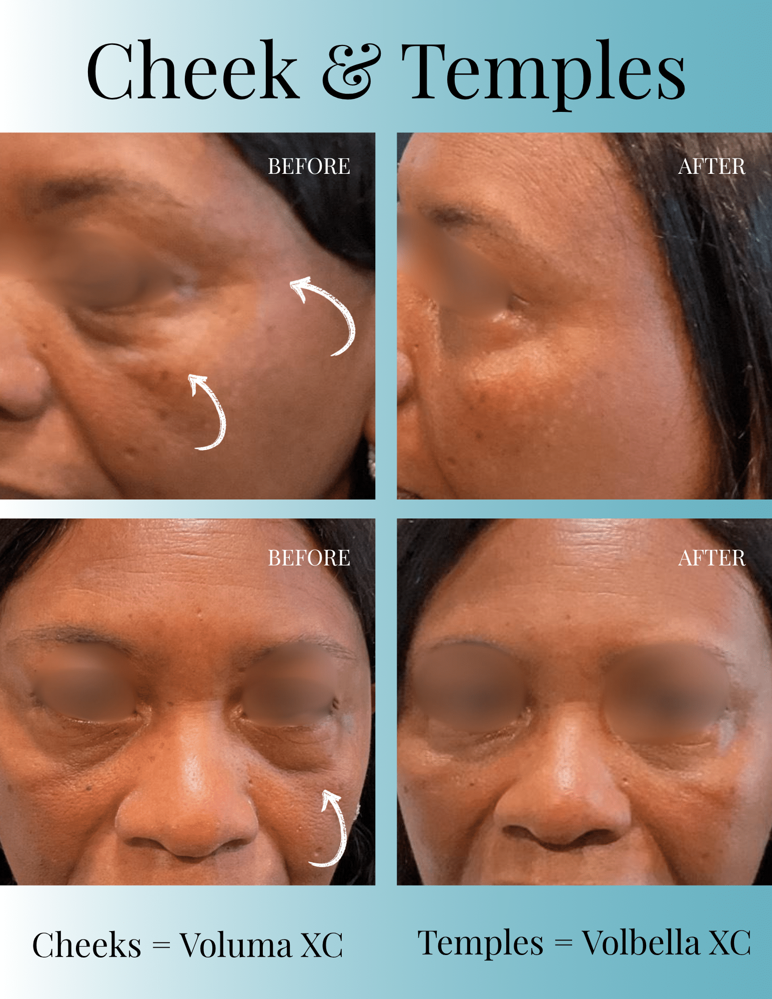 Before and After Image: Cheek & Temple Filler Before & After | Milledgeville, GA - front