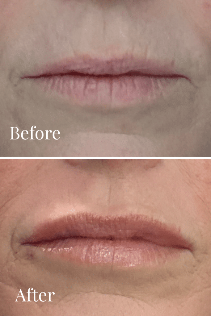 Before and After Image: Lip Filler - front