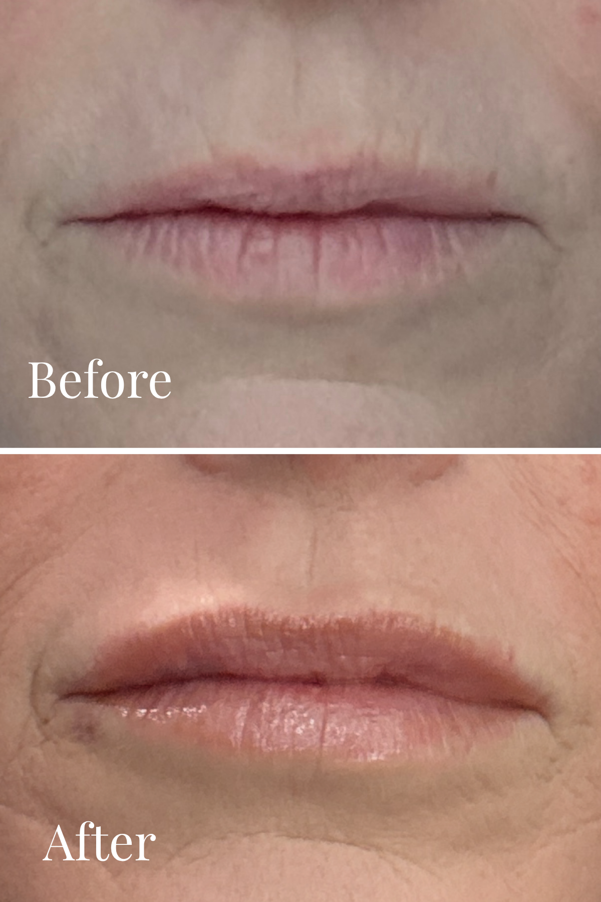 Before and After Image: Lip Filler - front