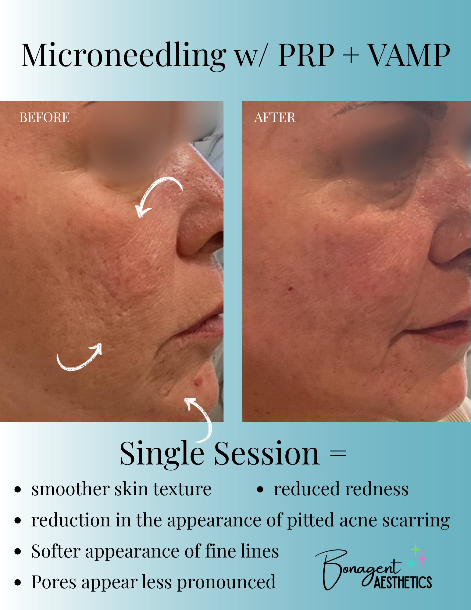 Before and After Image: PRP Microneedling & VAMP Treatment in Milledgeville, GA | Bonagent - front