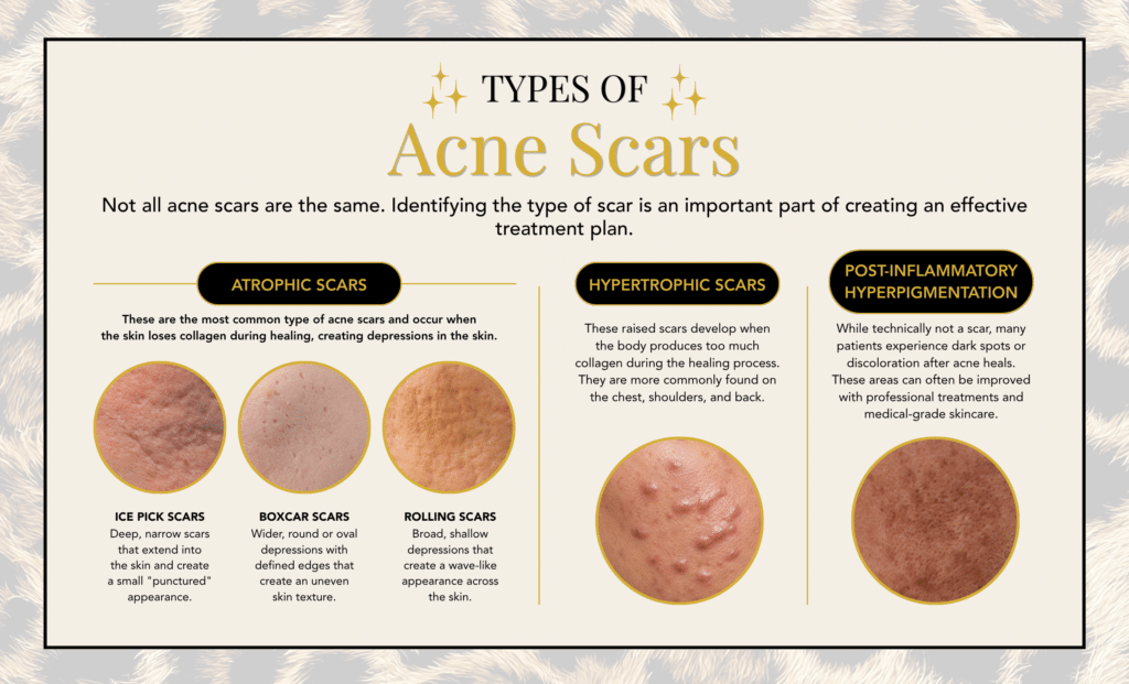 Types of Acne Scars | Bonagent Aesthetics Types of acne scars including ice pick scars, boxcar scars, rolling scars, hypertrophic scars, and post-inflammatory hyperpigmentation