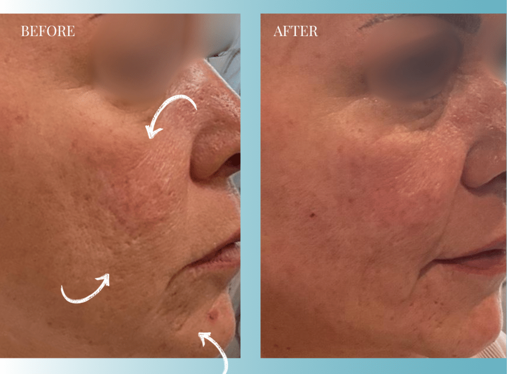 Acne Scar Treatment Before and After | Microneedling with PRP and VAMP Before and after acne scar treatment using microneedling with PRP and VAMP at Bonagent Aesthetics in Milledgeville GA